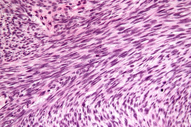 1280px-Malignant_peripheral_nerve_sheath_tumour_-_very_high_mag.jpg