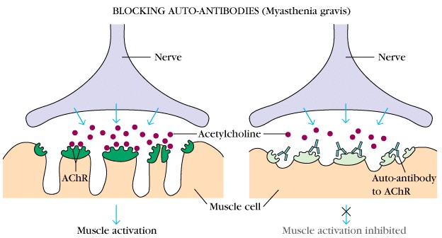 Myasthenia-Gravis.jpg